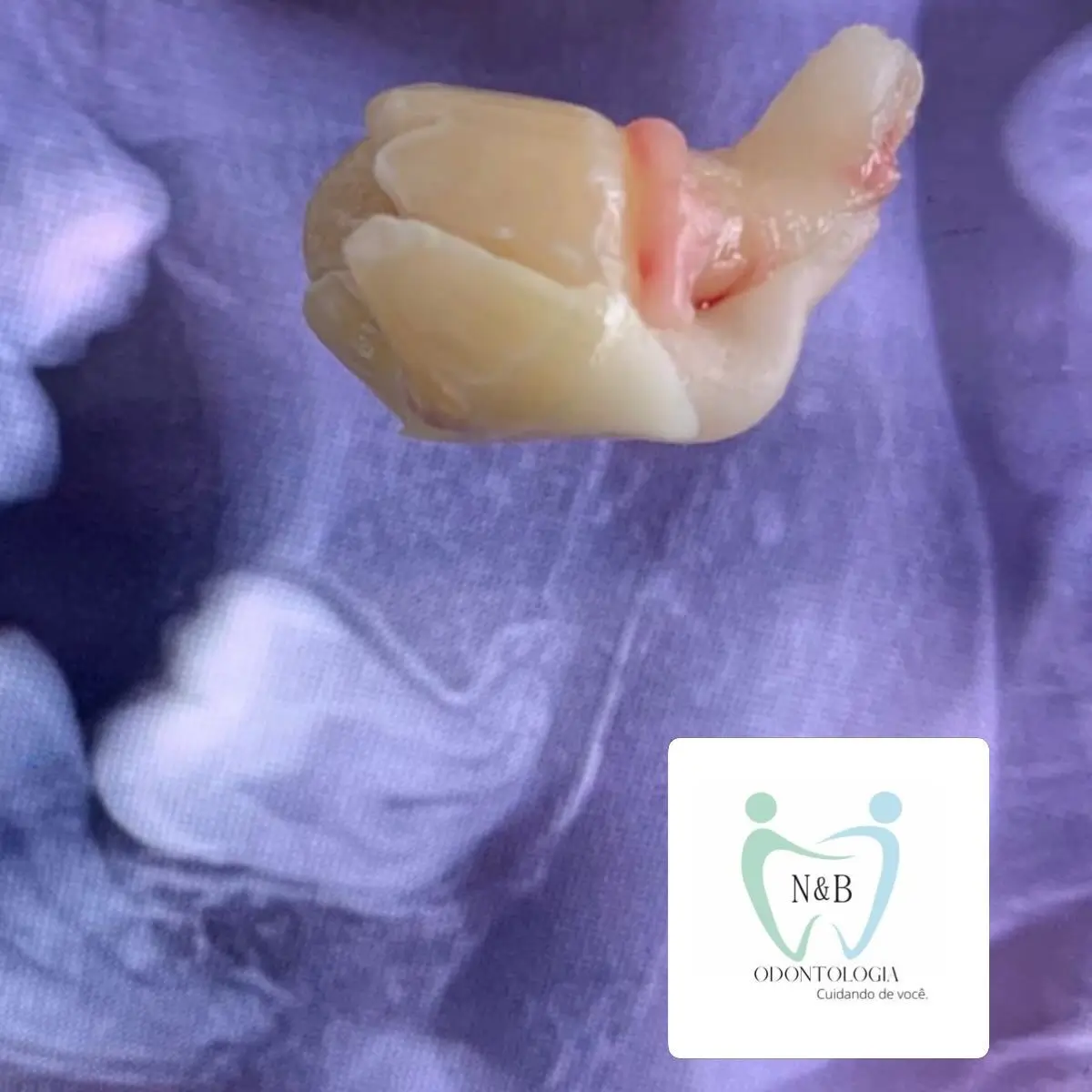 Cirurgia de siso — caso clínico 1