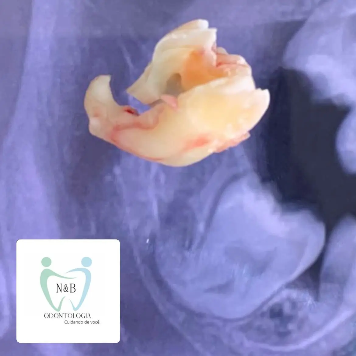 Cirurgia de siso — caso clínico 2